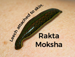 Leech attached to skin for Rakta Moksha